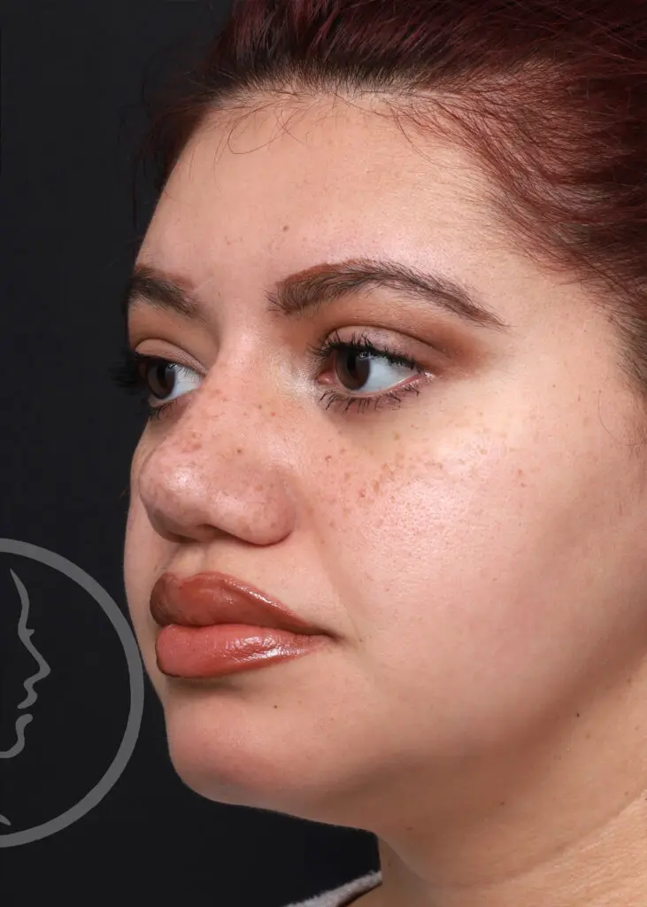 Plastic Surgery Before and After Pictures in Jacksonville, FL - Garcia Facial Plastic Surgery