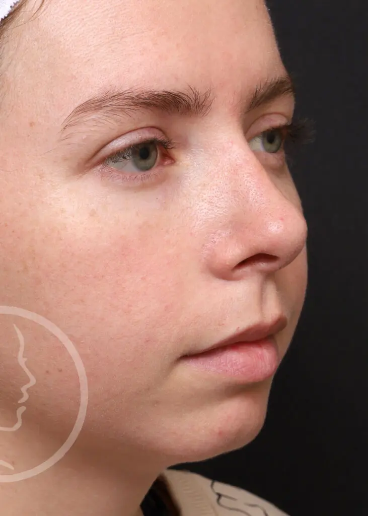 Plastic Surgery Before and After Pictures in Jacksonville, FL - Garcia Facial Plastic Surgery