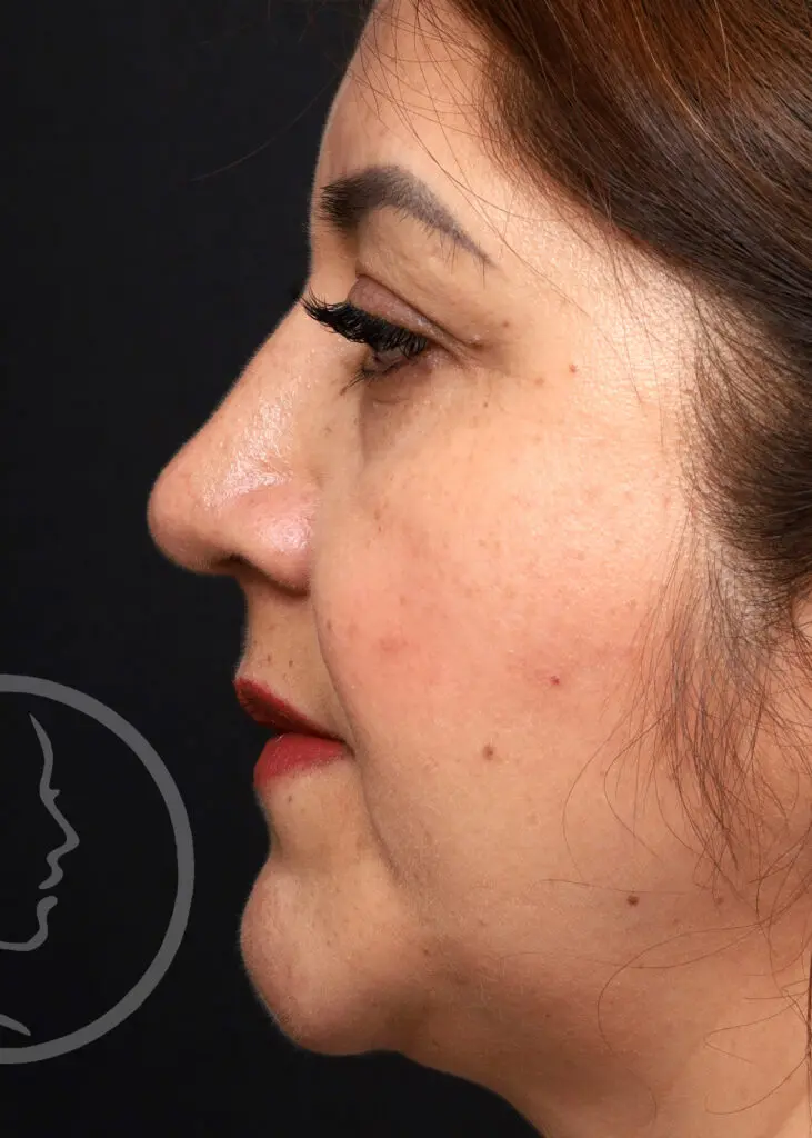 Plastic Surgery Before and After Pictures in Jacksonville, FL - Garcia Facial Plastic Surgery