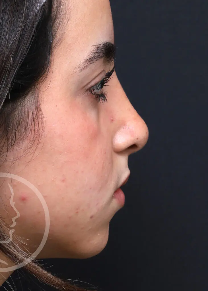 Plastic Surgery Before and After Pictures in Jacksonville, FL - Garcia Facial Plastic Surgery