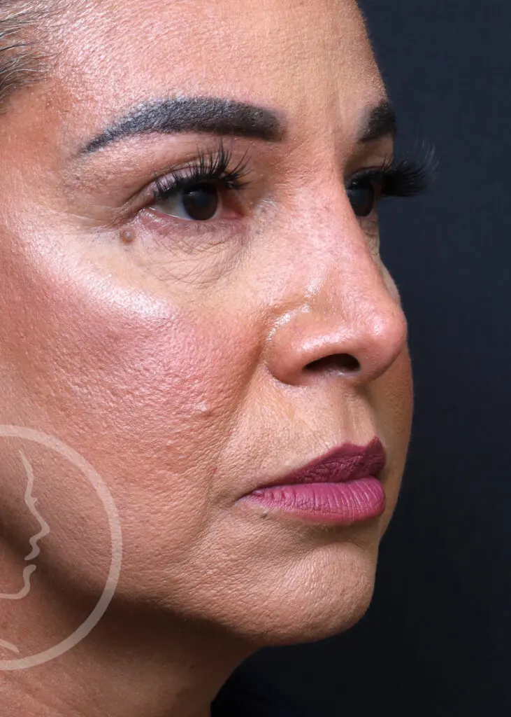 Plastic Surgery Before and After Pictures in Jacksonville, FL - Garcia Facial Plastic Surgery