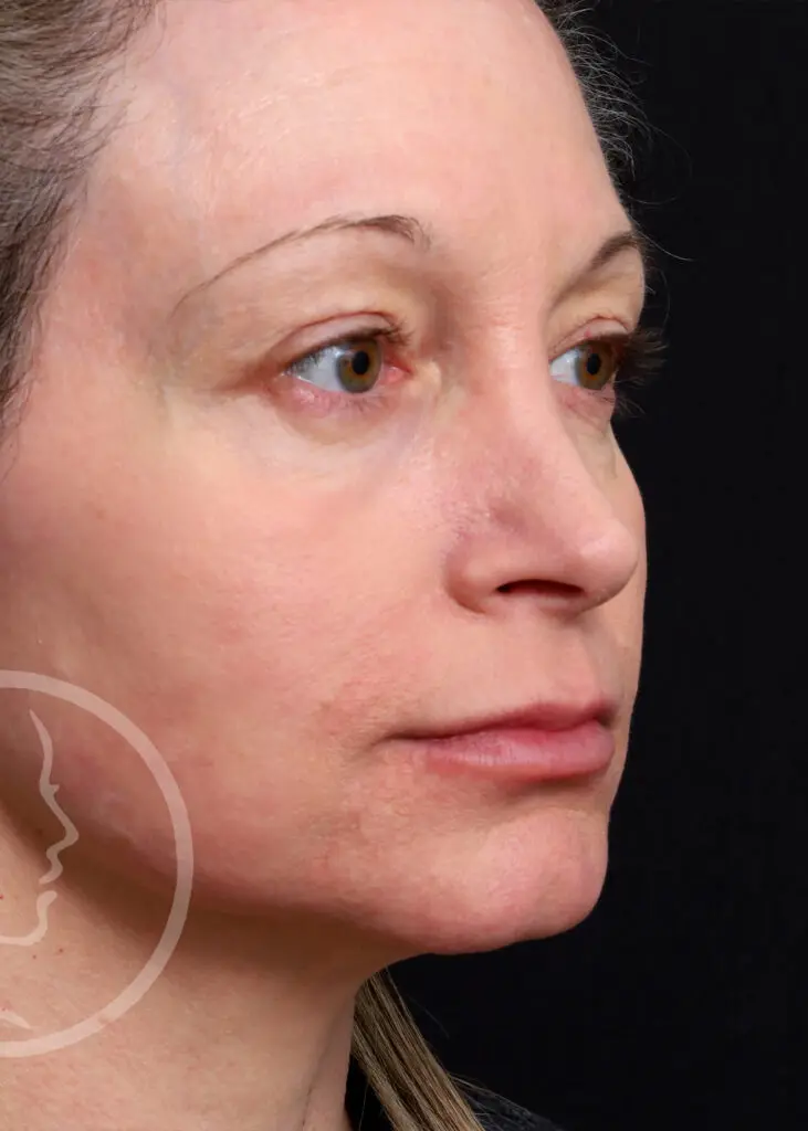 Plastic Surgery Before and After Pictures in Jacksonville, FL - Garcia Facial Plastic Surgery