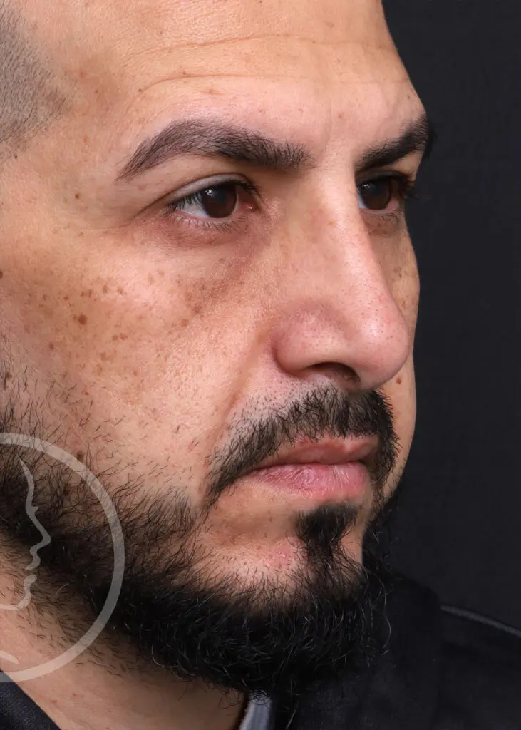 Plastic Surgery Before and After Pictures in Jacksonville, FL - Garcia Facial Plastic Surgery