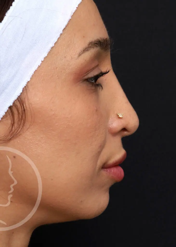 Plastic Surgery Before and After Pictures in Jacksonville, FL - Garcia Facial Plastic Surgery