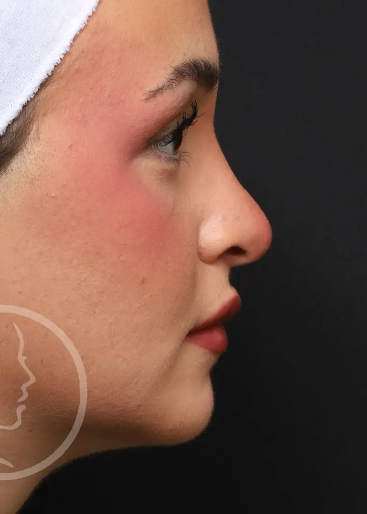 Plastic Surgery Before and After Pictures in Jacksonville, FL - Garcia Facial Plastic Surgery