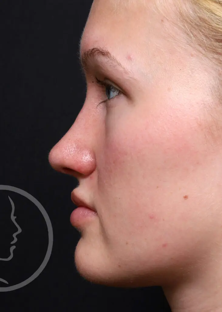 Plastic Surgery Before and After Pictures in Jacksonville, FL - Garcia Facial Plastic Surgery