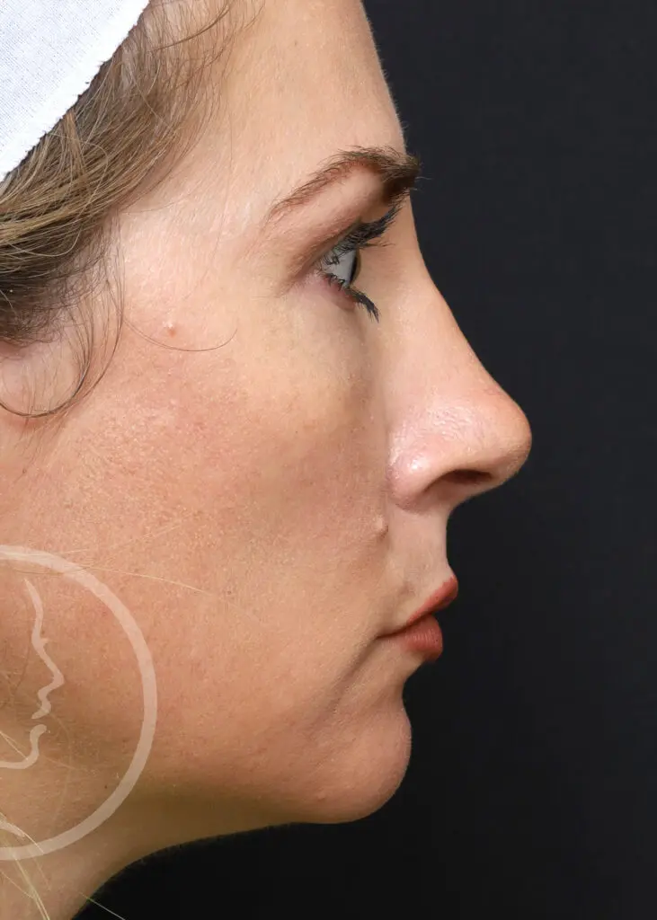 Plastic Surgery Before and After Pictures in Jacksonville, FL - Garcia Facial Plastic Surgery
