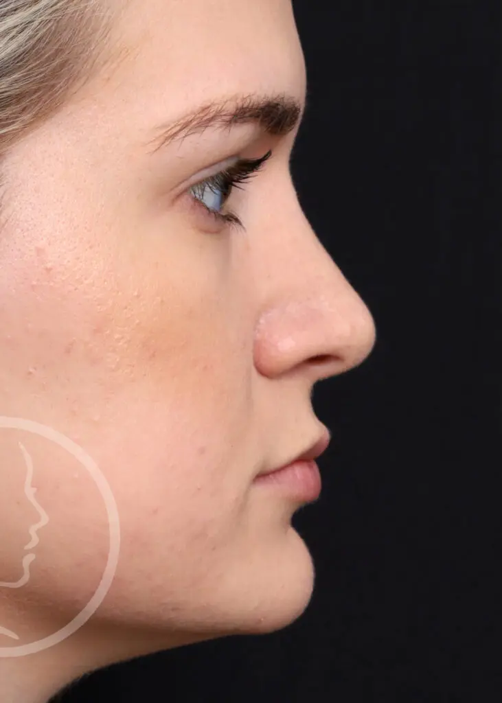 Plastic Surgery Before and After Pictures in Jacksonville, FL - Garcia Facial Plastic Surgery