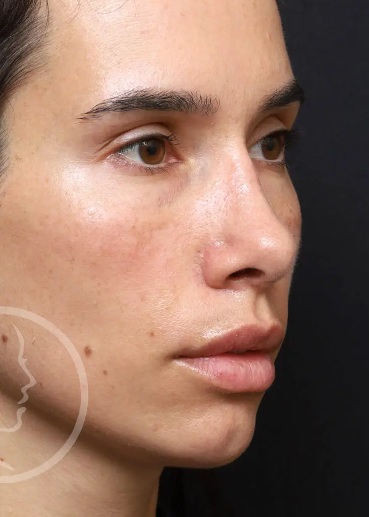 Plastic Surgery Before and After Pictures in Jacksonville, FL - Garcia Facial Plastic Surgery