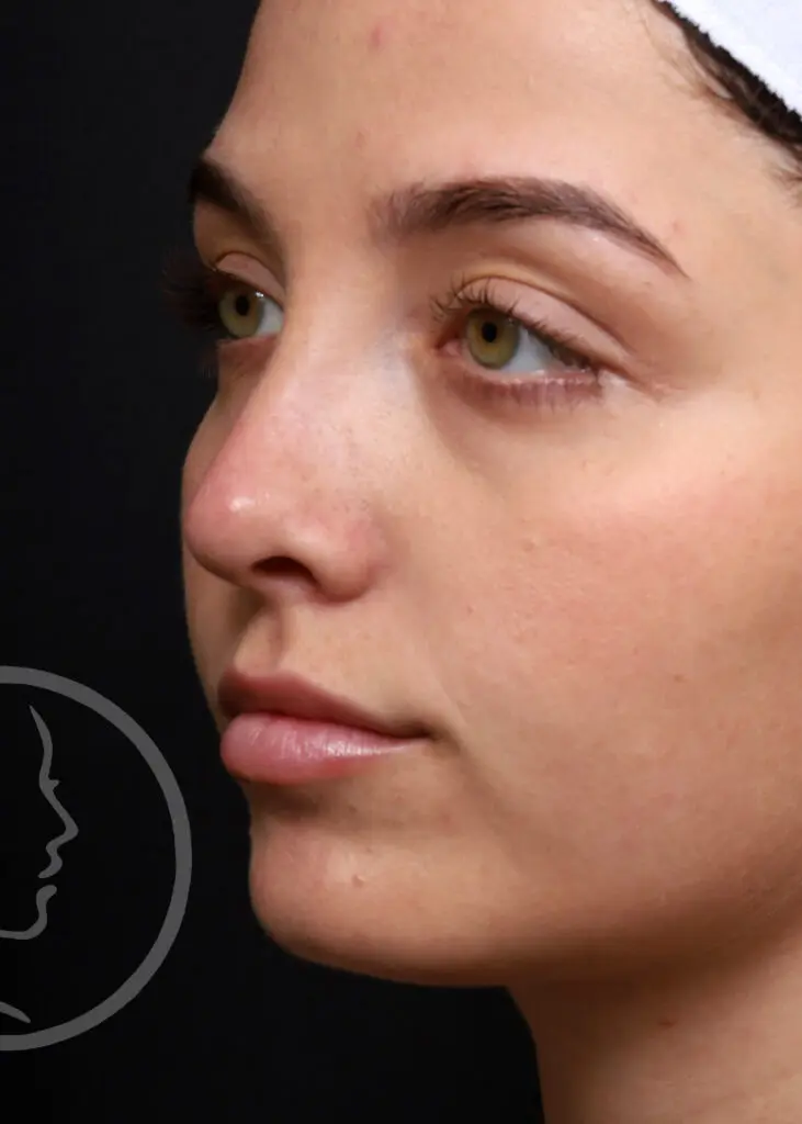 Plastic Surgery Before and After Pictures in Jacksonville, FL - Garcia Facial Plastic Surgery