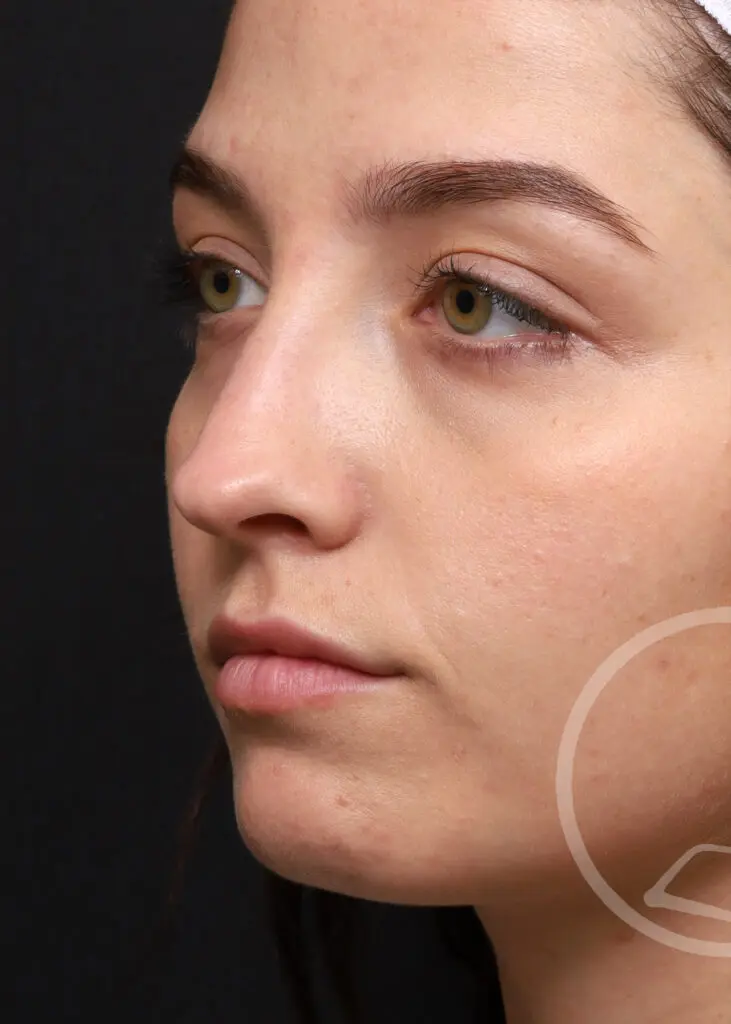 Plastic Surgery Before and After Pictures in Jacksonville, FL - Garcia Facial Plastic Surgery