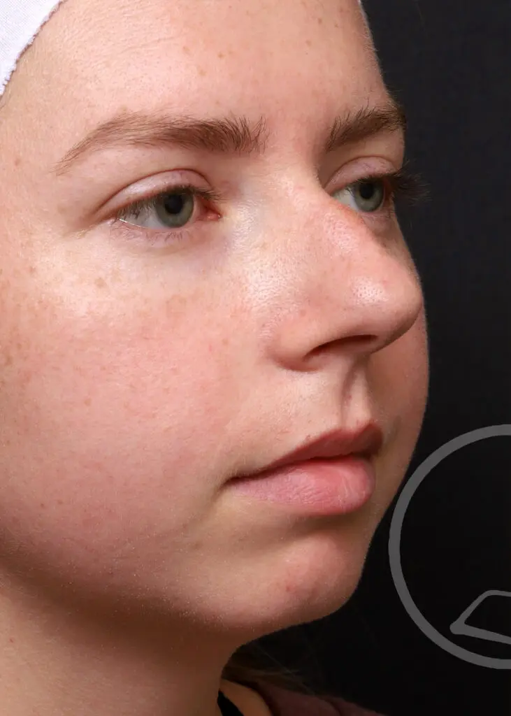 Plastic Surgery Before and After Pictures in Jacksonville, FL - Garcia Facial Plastic Surgery