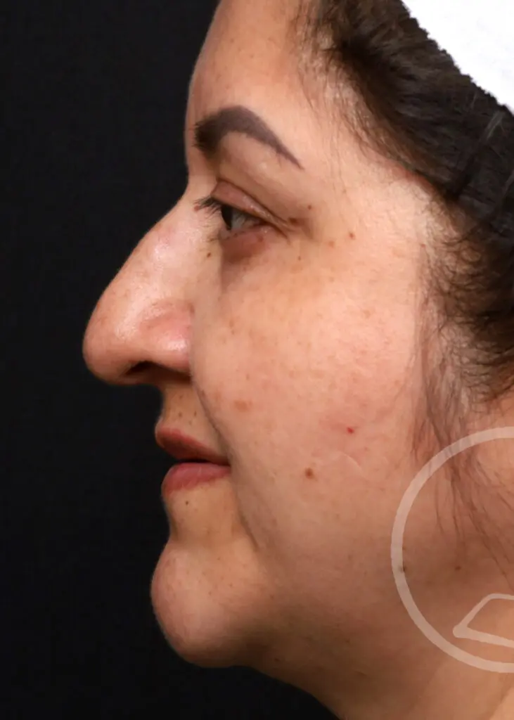 Plastic Surgery Before and After Pictures in Jacksonville, FL - Garcia Facial Plastic Surgery