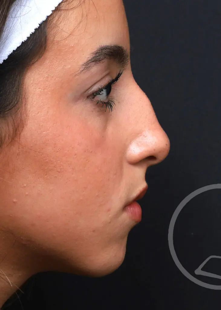 Plastic Surgery Before and After Pictures in Jacksonville, FL - Garcia Facial Plastic Surgery