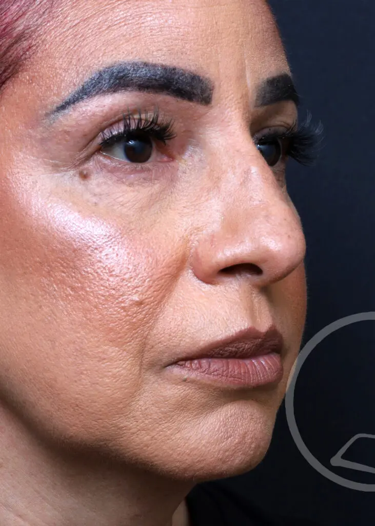 Plastic Surgery Before and After Pictures in Jacksonville, FL - Garcia Facial Plastic Surgery