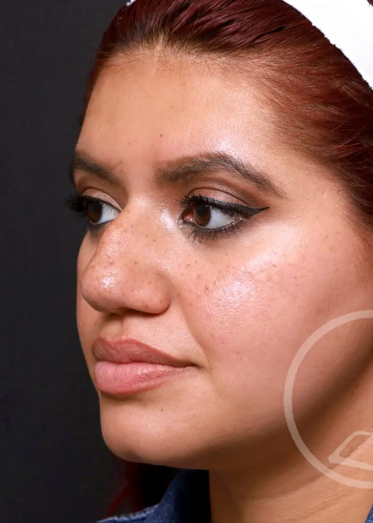 Plastic Surgery Before and After Pictures in Jacksonville, FL - Garcia Facial Plastic Surgery