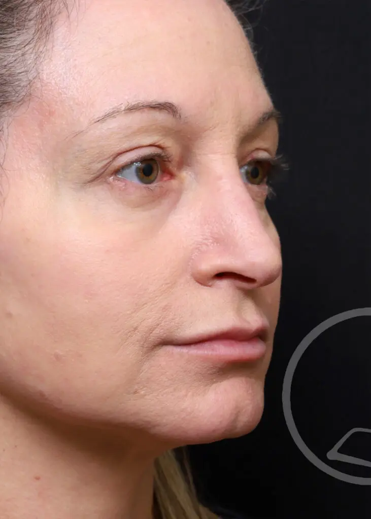 Plastic Surgery Before and After Pictures in Jacksonville, FL - Garcia Facial Plastic Surgery