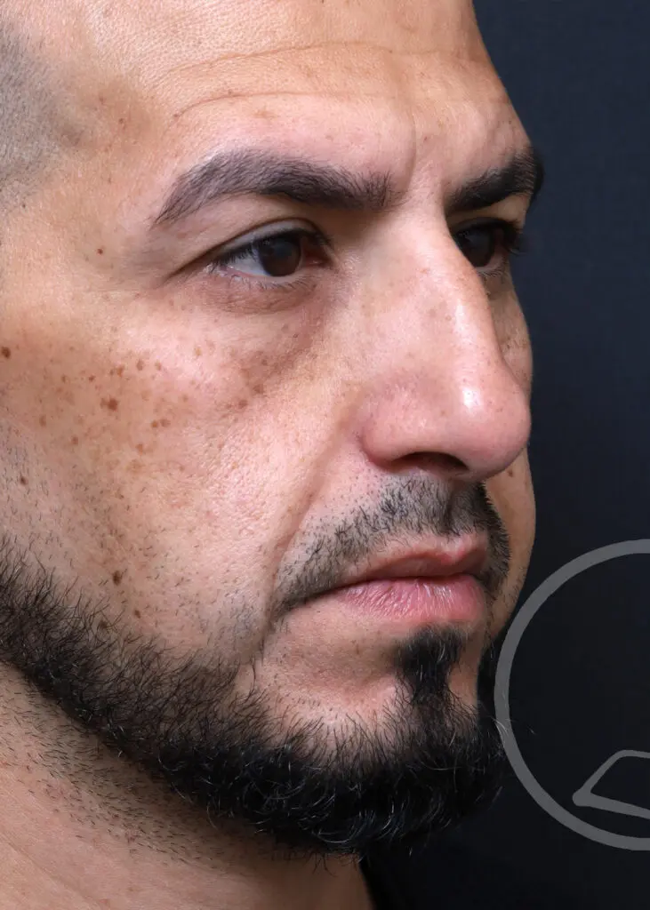 Plastic Surgery Before and After Pictures in Jacksonville, FL - Garcia Facial Plastic Surgery