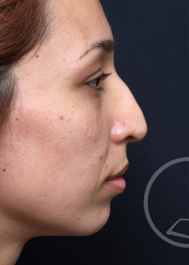 Plastic Surgery Before and After Pictures in Jacksonville, FL - Garcia Facial Plastic Surgery