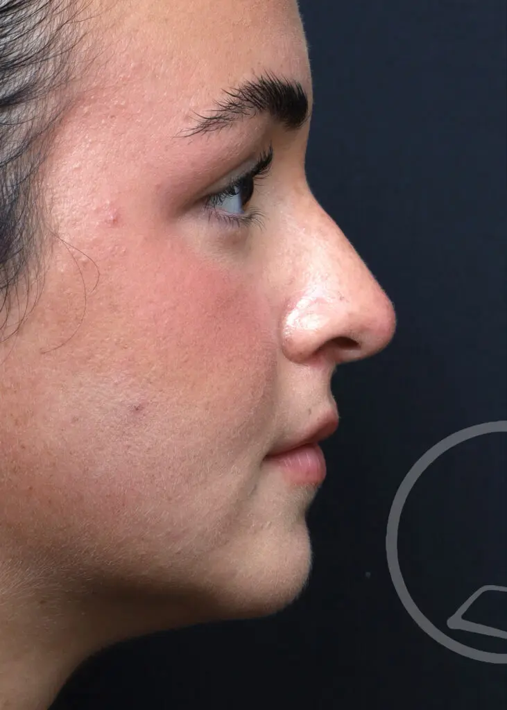 Plastic Surgery Before and After Pictures in Jacksonville, FL - Garcia Facial Plastic Surgery
