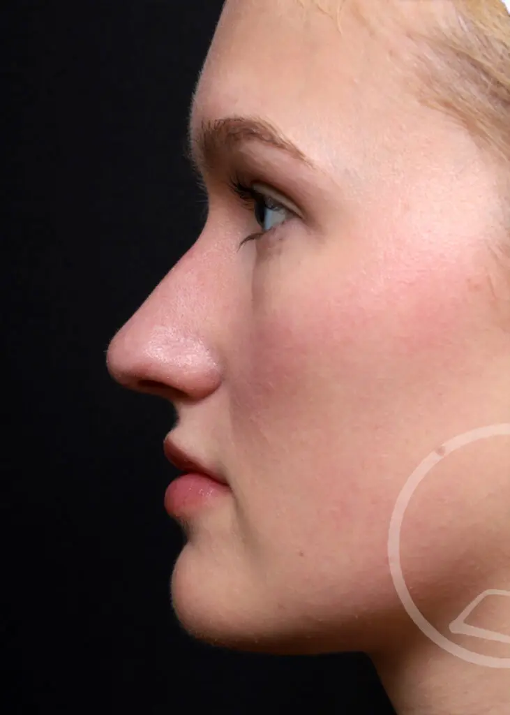 Plastic Surgery Before and After Pictures in Jacksonville, FL - Garcia Facial Plastic Surgery