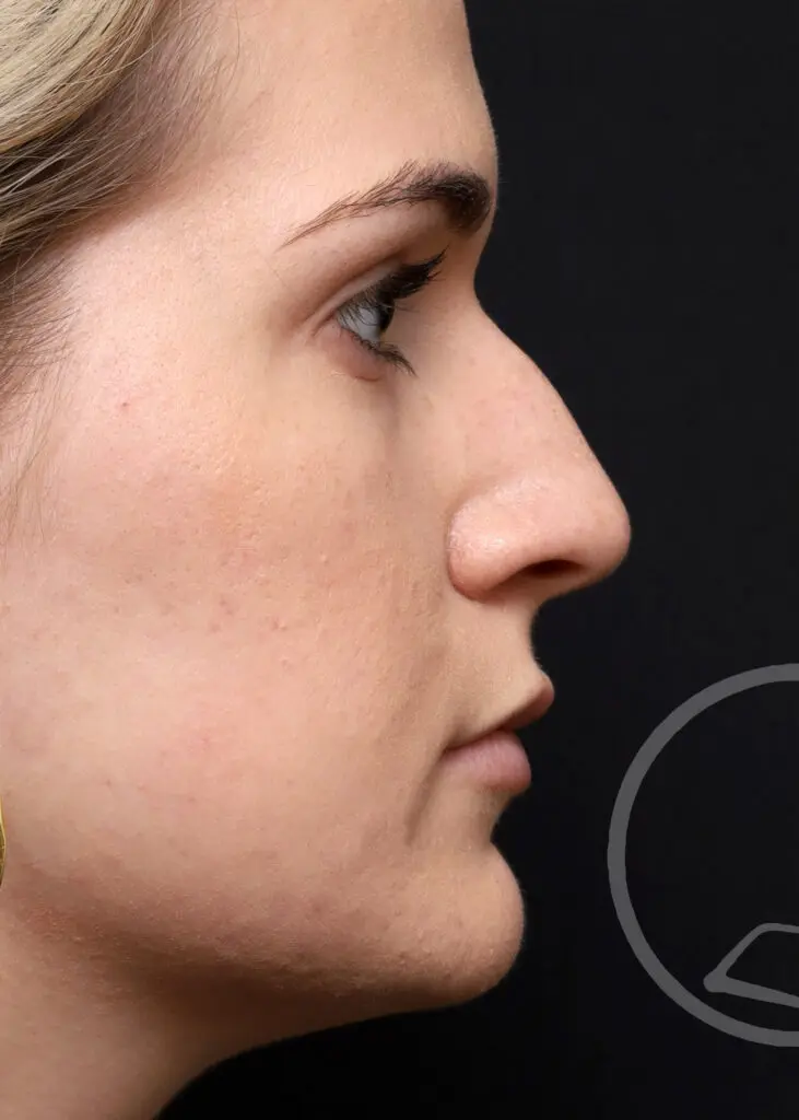 Plastic Surgery Before and After Pictures in Jacksonville, FL - Garcia Facial Plastic Surgery