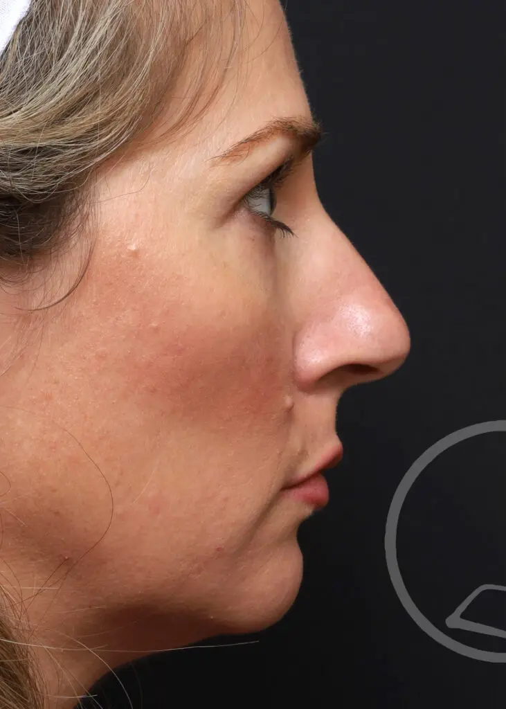 Plastic Surgery Before and After Pictures in Jacksonville, FL - Garcia Facial Plastic Surgery