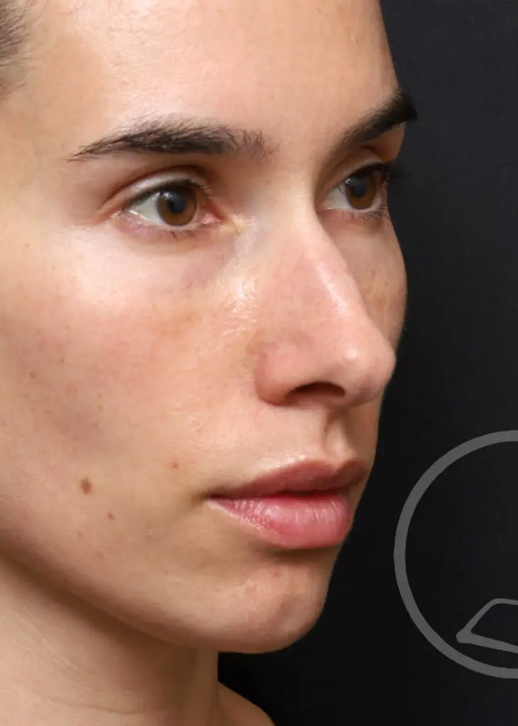 Plastic Surgery Before and After Pictures in Jacksonville, FL - Garcia Facial Plastic Surgery