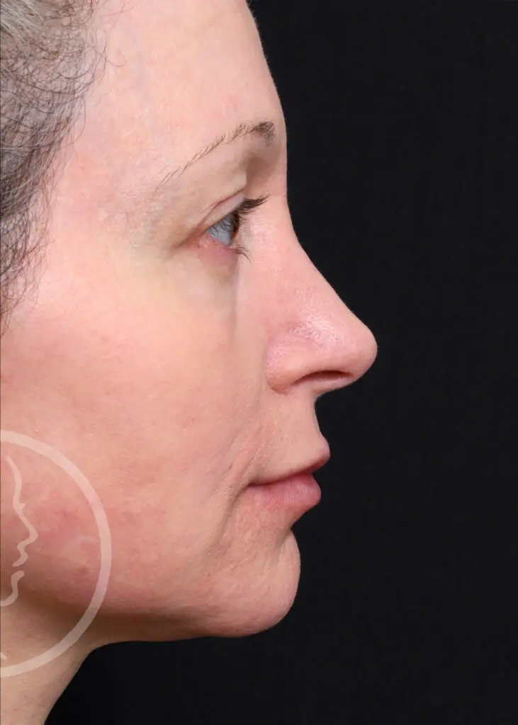 Plastic Surgery Before and After Pictures in Jacksonville, FL - Garcia Facial Plastic Surgery