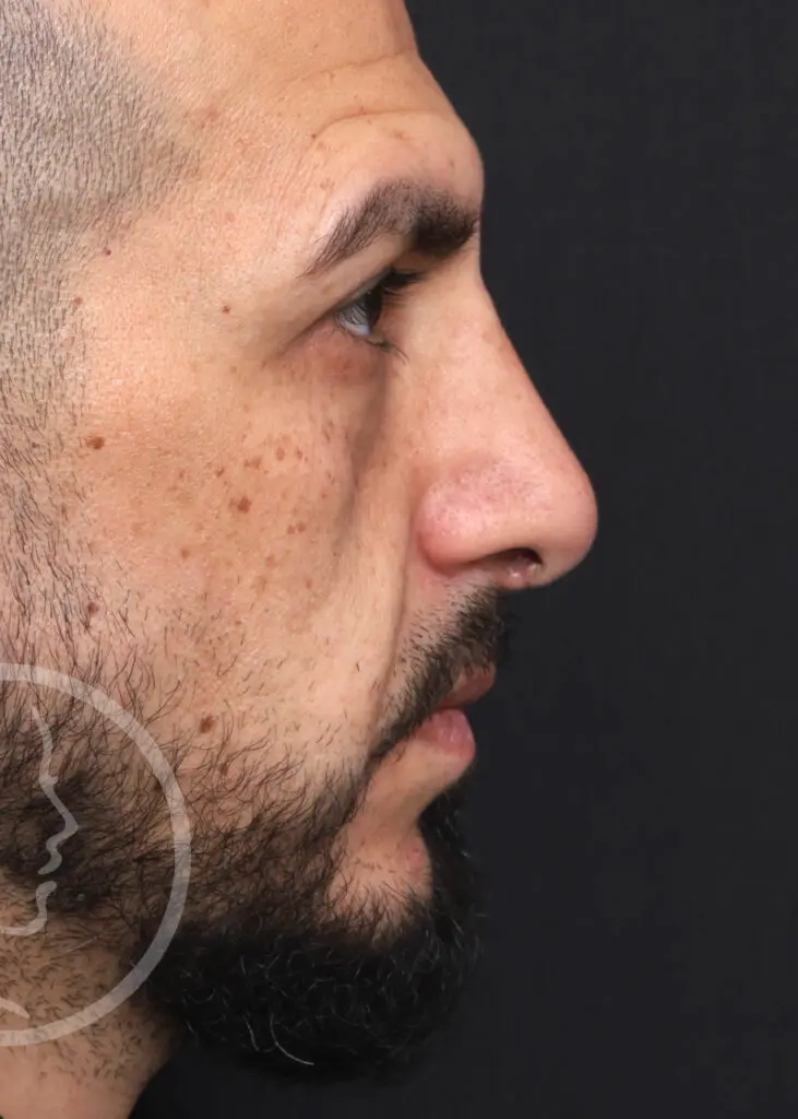 Plastic Surgery Before and After Pictures in Jacksonville, FL - Garcia Facial Plastic Surgery