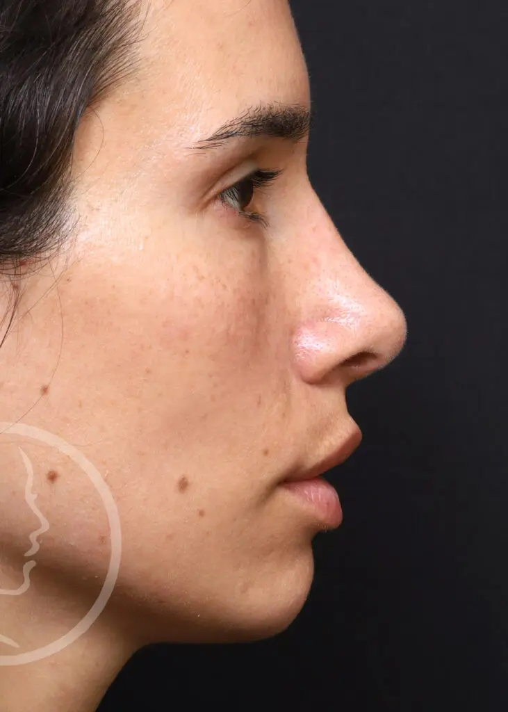 Plastic Surgery Before and After Pictures in Jacksonville, FL - Garcia Facial Plastic Surgery