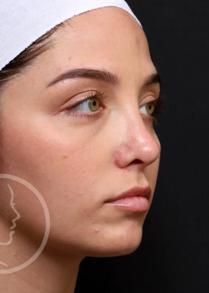 Plastic Surgery Before and After Pictures in Jacksonville, FL - Garcia Facial Plastic Surgery