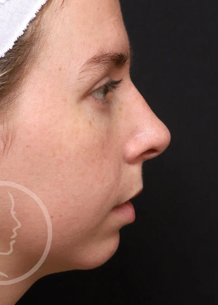 Plastic Surgery Before and After Pictures in Jacksonville, FL - Garcia Facial Plastic Surgery