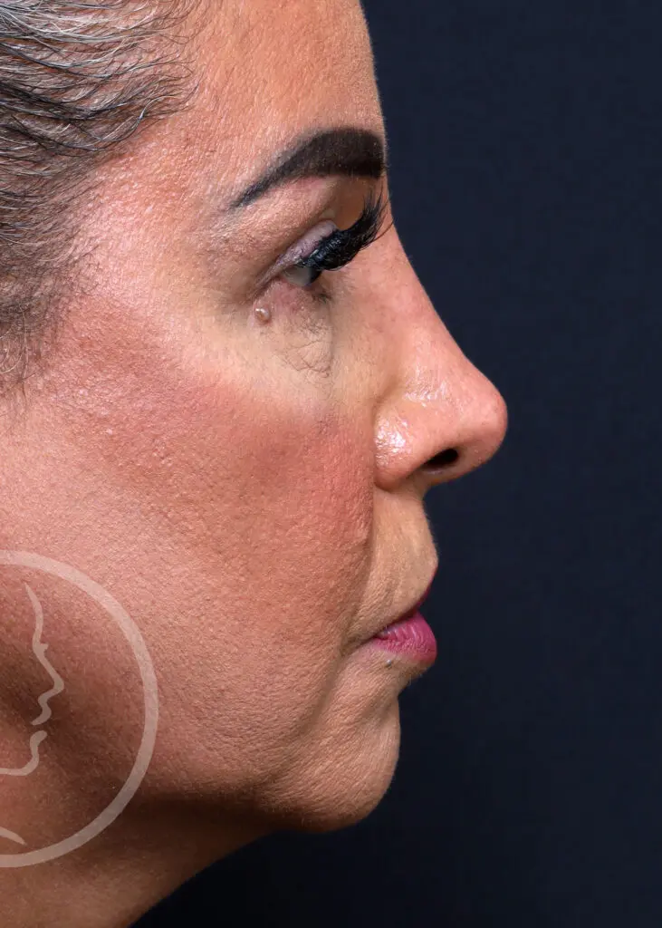 Plastic Surgery Before and After Pictures in Jacksonville, FL - Garcia Facial Plastic Surgery