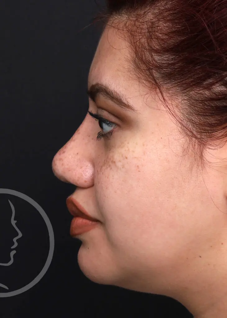 Plastic Surgery Before and After Pictures in Jacksonville, FL - Garcia Facial Plastic Surgery