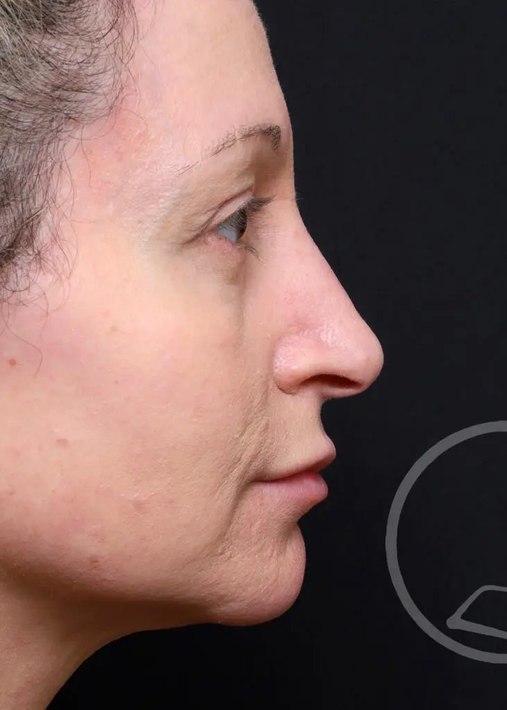 Plastic Surgery Before and After Pictures in Jacksonville, FL - Garcia Facial Plastic Surgery