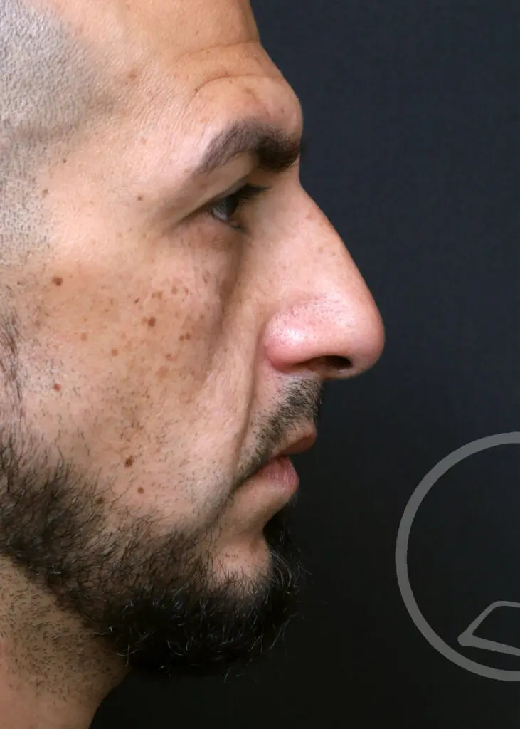 Plastic Surgery Before and After Pictures in Jacksonville, FL - Garcia Facial Plastic Surgery