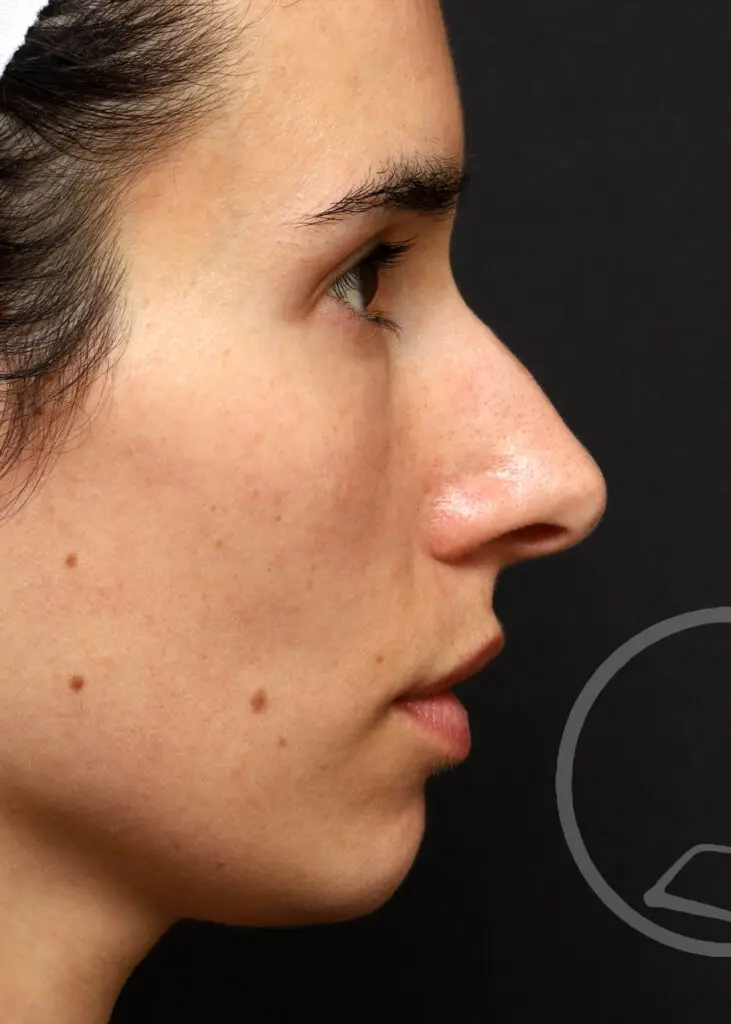 Plastic Surgery Before and After Pictures in Jacksonville, FL - Garcia Facial Plastic Surgery