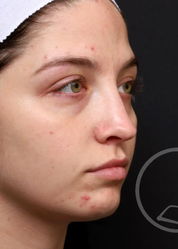Plastic Surgery Before and After Pictures in Jacksonville, FL - Garcia Facial Plastic Surgery