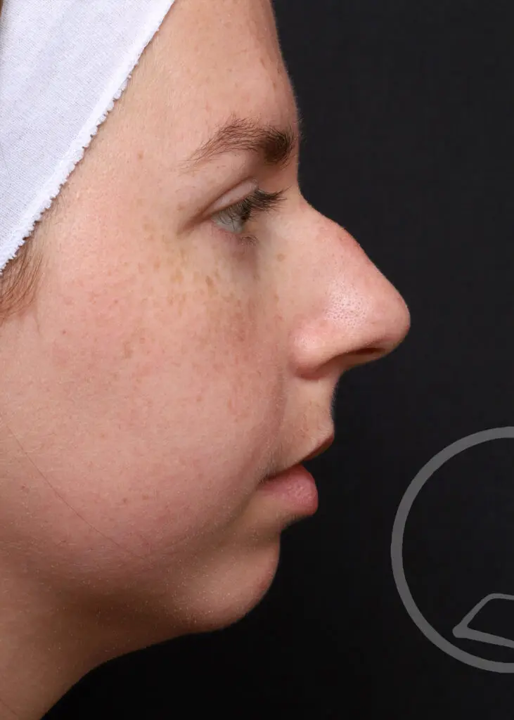 Plastic Surgery Before and After Pictures in Jacksonville, FL - Garcia Facial Plastic Surgery