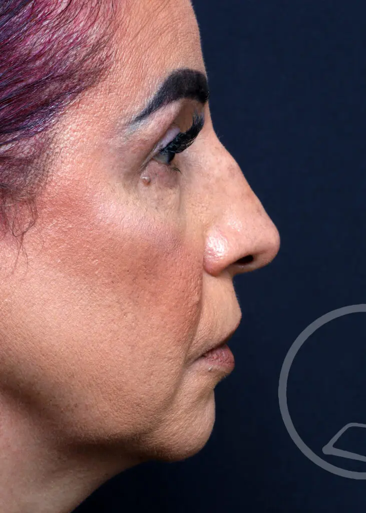 Plastic Surgery Before and After Pictures in Jacksonville, FL - Garcia Facial Plastic Surgery