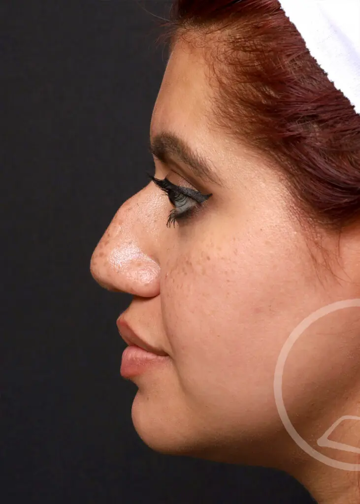 Plastic Surgery Before and After Pictures in Jacksonville, FL - Garcia Facial Plastic Surgery