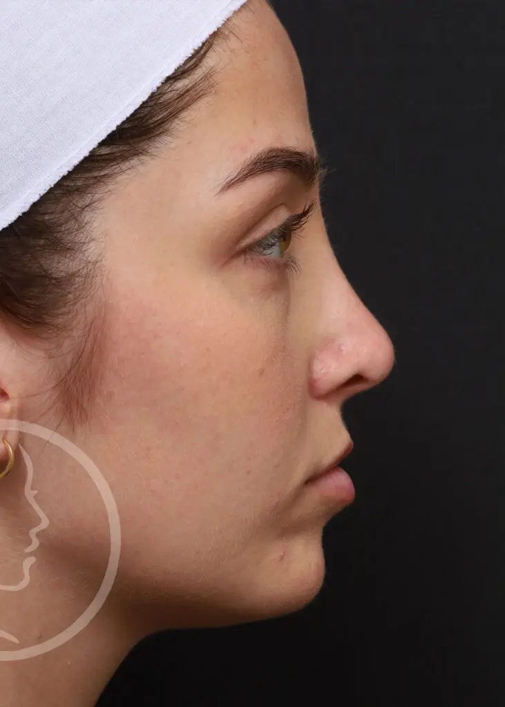 Plastic Surgery Before and After Pictures in Jacksonville, FL - Garcia Facial Plastic Surgery