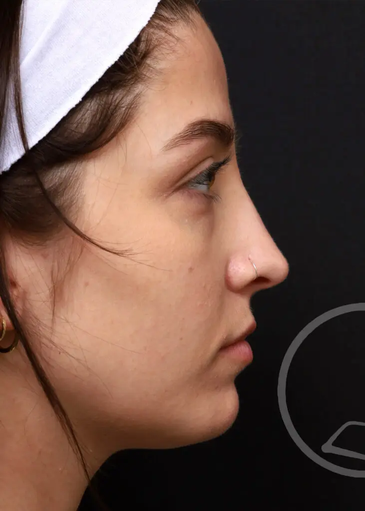 Plastic Surgery Before and After Pictures in Jacksonville, FL - Garcia Facial Plastic Surgery