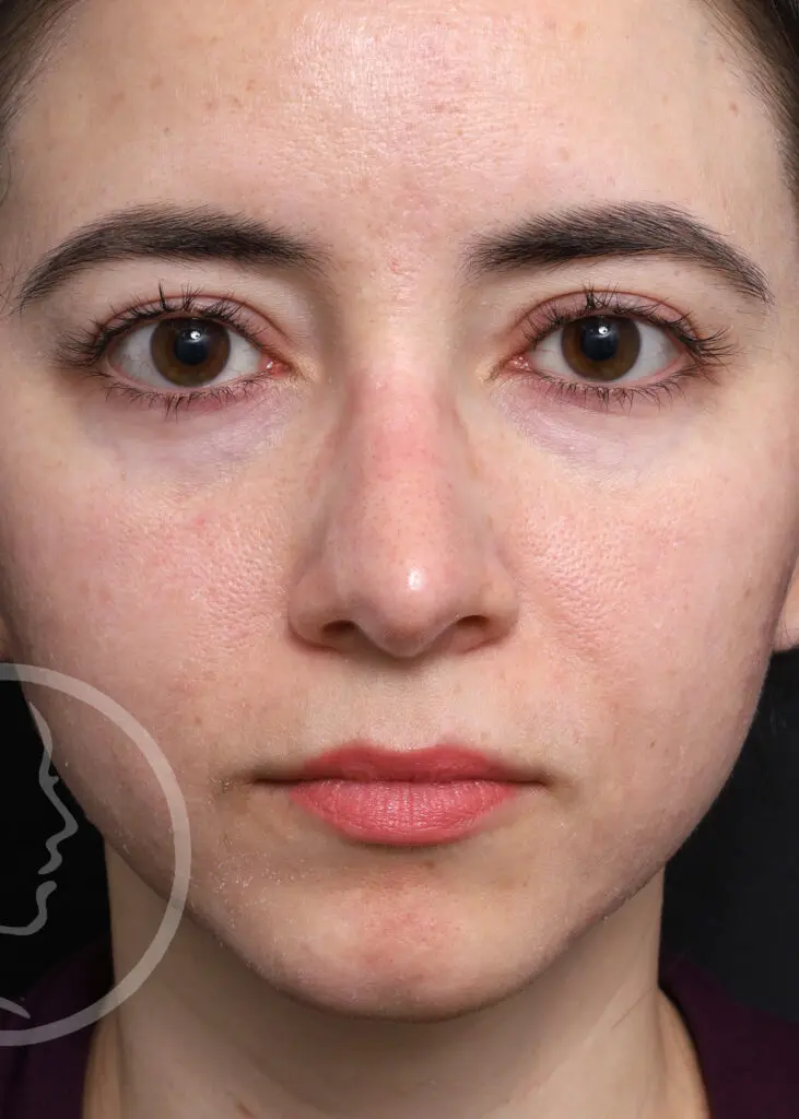 Plastic Surgery Before and After Pictures in Jacksonville, FL - Garcia Facial Plastic Surgery