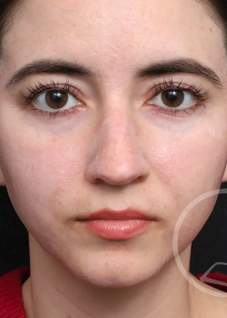 Plastic Surgery Before and After Pictures in Jacksonville, FL - Garcia Facial Plastic Surgery
