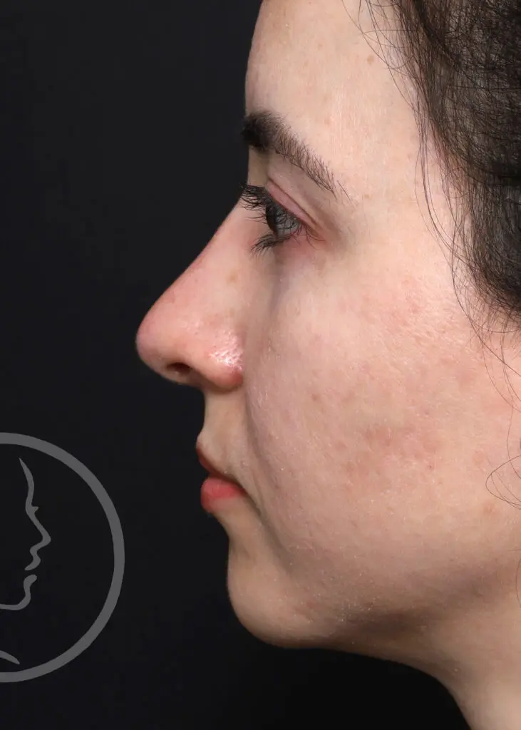 Plastic Surgery Before and After Pictures in Jacksonville, FL - Garcia Facial Plastic Surgery