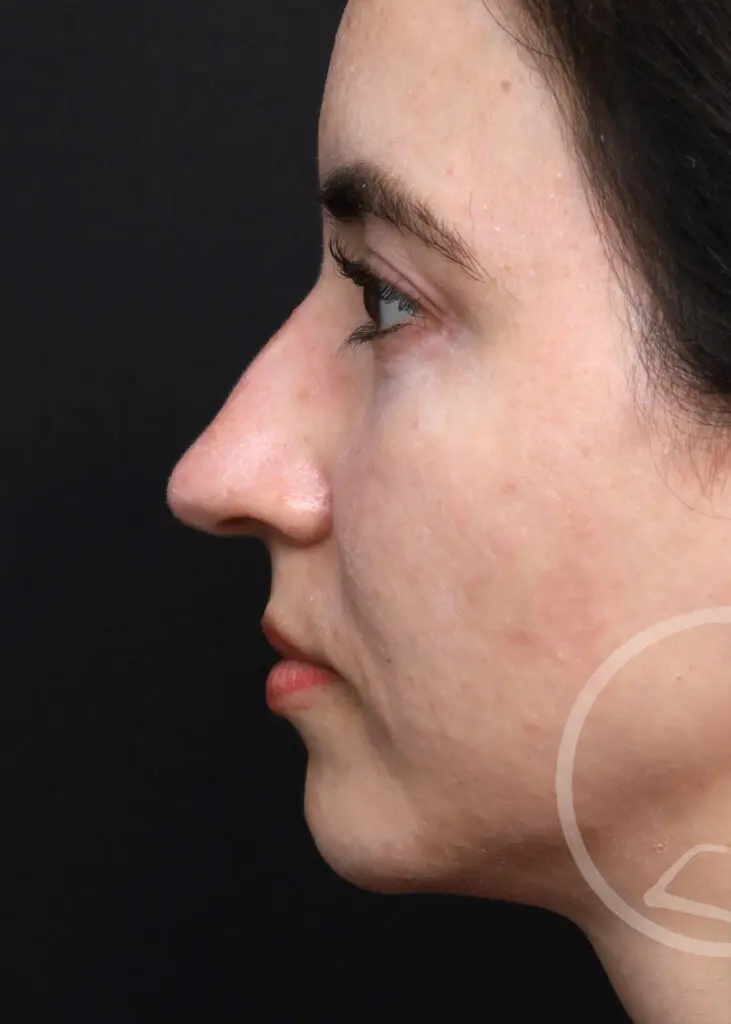 Plastic Surgery Before and After Pictures in Jacksonville, FL - Garcia Facial Plastic Surgery