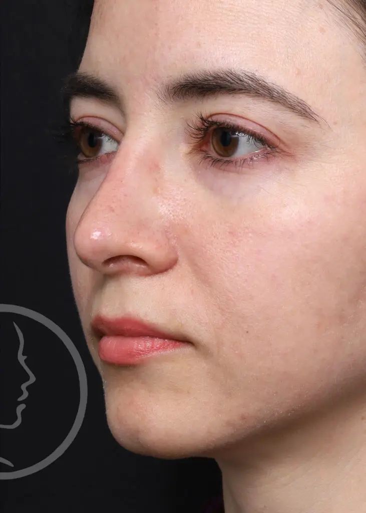 Plastic Surgery Before and After Pictures in Jacksonville, FL - Garcia Facial Plastic Surgery