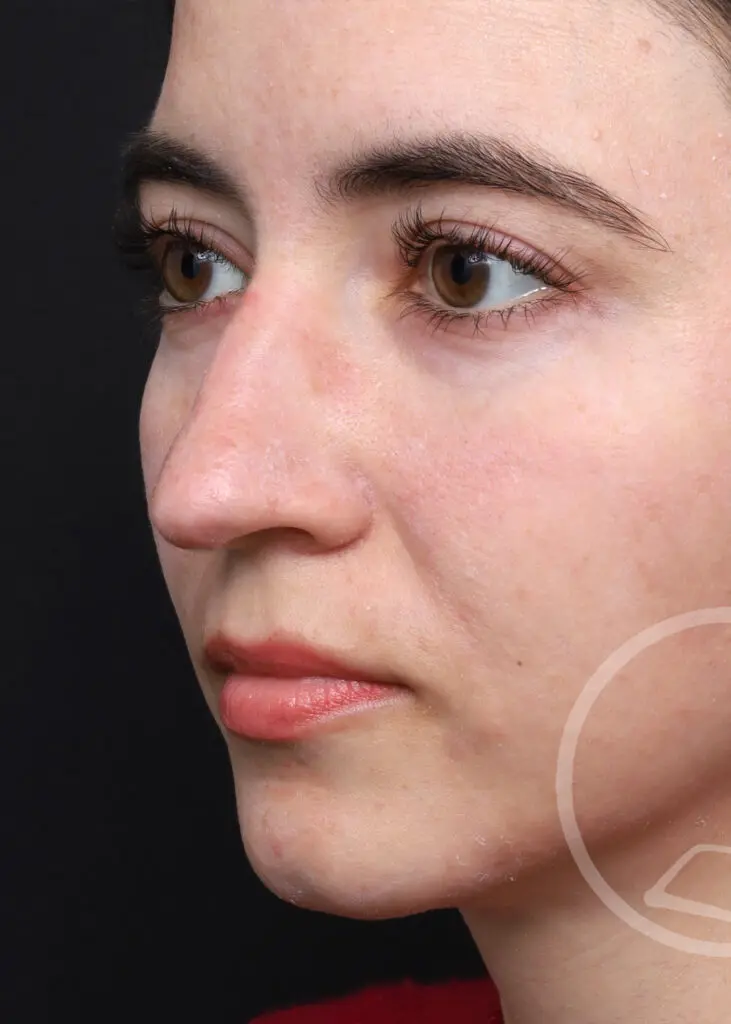Plastic Surgery Before and After Pictures in Jacksonville, FL - Garcia Facial Plastic Surgery